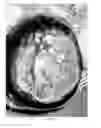 Fig. 06 - Pharmaceutical compositions for treating thermal injuries and wounds combined with bone injuries