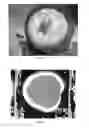 Fig. 12 - Pharmaceutical compositions for treating thermal injuries and wounds combined with bone injuries