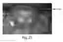 Fig. 21 - Autoassembling peptides for the treatment of pulmonary bulla