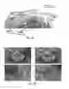 Fig. 24 - Autoassembling peptides for the treatment of pulmonary bulla