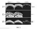 Fig. 02 - Method of administering MANF for the protection of sensory cells