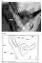 Fig. 41 - Method for controlling work time for forming shape of biphasic self-setting calcium phosphate