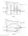 Fig. 07 - INFLATABLE TRANSLUMENAL SHUNTS AND METHODS AND DEVICES FOR DELIVERY
