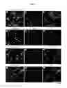 Fig. 05 - Diagnosis of multiple sclerosis