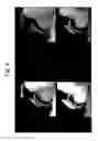 Fig. 05 - Motion corrected simultaneously acquired multiple contrast coronary MRI systems and methods