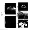 Fig. 08 - Motion corrected simultaneously acquired multiple contrast coronary MRI systems and methods