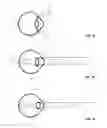 Fig. 02 - Adjustable contact lens system
