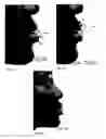 Fig. 12 - Image analysis for determining characteristics of pairs of individuals