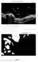 Fig. 02 - Vitreoretinal membrane characterization using optical coherence tomography