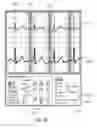 Fig. 36 - Apparatus and method for catheter navigation using endovascular energy mapping