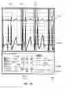 Fig. 40 - Apparatus and method for catheter navigation using endovascular energy mapping