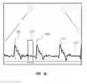 Fig. 47 - Apparatus and method for catheter navigation using endovascular energy mapping