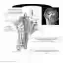 Fig. 02 - MRI-guided intraarterial catheter-based method for predicting territory of local blood brain barrier opening
