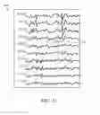 Fig. 12 - Method and system for detecting and removing EEG artifacts