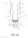 Fig. 35 - DIVERTICULUM INVERSION USING A CLIP PLACEMENT DEVICE