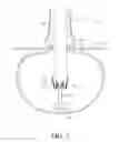 Fig. 37 - DIVERTICULUM INVERSION USING A CLIP PLACEMENT DEVICE