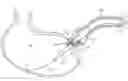 Fig. 01 - ENDOLUMENAL RESTRICTION METHOD AND APPARATUS