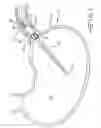 Fig. 02 - ENDOLUMENAL RESTRICTION METHOD AND APPARATUS