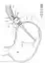 Fig. 05 - ENDOLUMENAL RESTRICTION METHOD AND APPARATUS