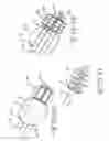 Fig. 12 - ENDOLUMENAL RESTRICTION METHOD AND APPARATUS