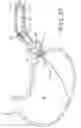 Fig. 25 - ENDOLUMENAL RESTRICTION METHOD AND APPARATUS