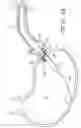 Fig. 26 - ENDOLUMENAL RESTRICTION METHOD AND APPARATUS