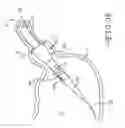 Fig. 27 - ENDOLUMENAL RESTRICTION METHOD AND APPARATUS