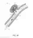 Fig. 05 - Detachable tip microcatheter