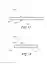 Fig. 14 - Detachable tip microcatheter