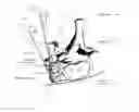 Fig. 01 - Vetebral osteotomy saw guide