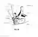 Fig. 03 - Vetebral osteotomy saw guide