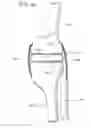 Fig. 47 - METHOD AND APPARATUS FOR FEMORAL RESECTION ALIGNMENT