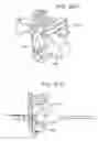 Fig. 61 - METHOD AND APPARATUS FOR FEMORAL RESECTION ALIGNMENT