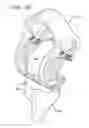 Fig. 74 - METHOD AND APPARATUS FOR FEMORAL RESECTION ALIGNMENT