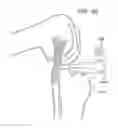 Fig. 76 - METHOD AND APPARATUS FOR FEMORAL RESECTION ALIGNMENT