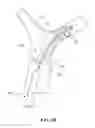 Fig. 10 - Retraction and aspiration device for treating embolism and associated systems and methods