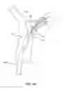 Fig. 12 - Retraction and aspiration device for treating embolism and associated systems and methods