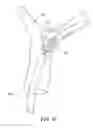 Fig. 14 - Retraction and aspiration device for treating embolism and associated systems and methods