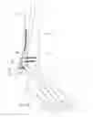 Fig. 19 - Flexible bone implant