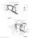 Fig. 06 - Method and devices for coagulation of tissue
