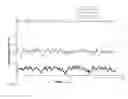 Fig. 09 - Catheter stability indication