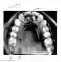 Fig. 01 - Orthodontic appliance for distalization and/or space closure