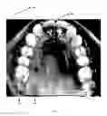 Fig. 06 - Orthodontic appliance for distalization and/or space closure