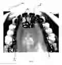 Fig. 08 - Orthodontic appliance for distalization and/or space closure