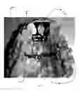 Fig. 11 - Orthodontic appliance for distalization and/or space closure