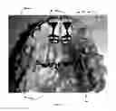 Fig. 12 - Orthodontic appliance for distalization and/or space closure