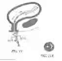 Fig. 12 - Attenuation device for use in an anatomical structure