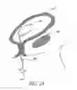 Fig. 22 - Attenuation device for use in an anatomical structure