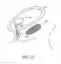 Fig. 23 - Attenuation device for use in an anatomical structure