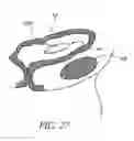 Fig. 26 - Attenuation device for use in an anatomical structure